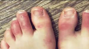covid toes 